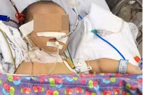 Nhiễm độc ammoniac vì rối loạn chuyển hóa bẩm sinh 