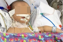 Nhiễm độc ammoniac vì rối loạn chuyển hóa bẩm sinh 