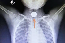 Đi chúc tết, bé trai 5 tuổi nuốt đồng xu phải cấp cứu 