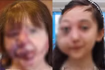 Mất cả gò má vì tự tẩy nốt ruồi