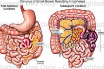 Đau bụng, nôn trớ cẩn thận hoại tử ruột