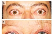 Thuốc Statin có tác dụng điều trị bệnh mắt do Basedow