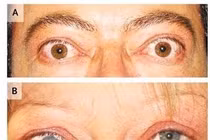 Thuốc Statin có tác dụng điều trị bệnh mắt do Basedow