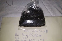 Cứu bệnh nhân có 721 viên sỏi trong túi mật