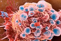 AIDS có tiến triển thành ung thư không?