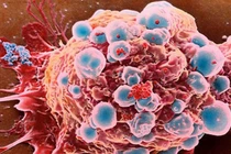 AIDS có tiến triển thành ung thư không?