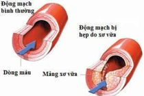 Xơ vữa mạch vì không uống thuốc