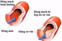 Xơ vữa mạch vì không uống thuốc