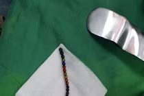 Cấp cứu bé trai nuốt 25 viên bi nam châm gây tắc và thủng ruột