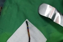 Cấp cứu bé trai nuốt 25 viên bi nam châm gây tắc và thủng ruột