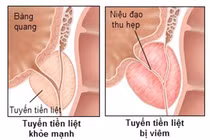 Tiểu đau và niệu đạo có mủ là biểu hiện của bệnh gì?