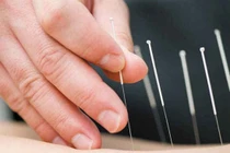 Châm cứu có thải được sỏi?