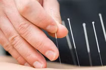 Châm cứu có thải được sỏi?