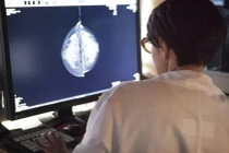 Công nghệ máy học chẩn đoán ung thư vú