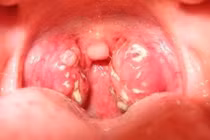 Trẻ ngủ ngáy cẩn thận viêm amidan quá phát 