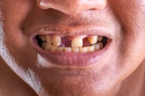 Các nhà khoa học tìm ra cách có thể giúp con người mọc lại răng