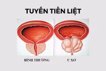 Bài thuốc trị u xơ tiền liệt tuyến