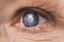  Glocom thứ phát và đục thủy tinh thể do sử dụng corticoid