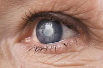  Glocom thứ phát và đục thủy tinh thể do sử dụng corticoid