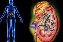  Sốt cao + tiểu bất thường dễ viêm thận bể thận cấp