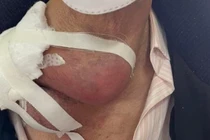 Chủ quan không chữa hạch thành di căn