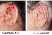 Tưởng nốt ruồi son hóa ung thư tai