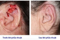 Tưởng nốt ruồi son hóa ung thư tai