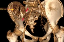 Nút mạch lấy u máu khổng lồ trong xương chậu cho trẻ 12 tuổi