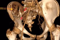 Nút mạch lấy u máu khổng lồ trong xương chậu cho trẻ 12 tuổi