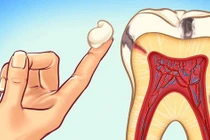 Nha sĩ tiết lộ 10 cách đơn giản để ngăn ngừa sâu răng