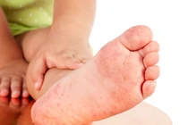 Viêm da cơ địa, phải kiên trì điều trị