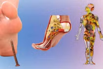 Các bệnh có thể dự phòng bằng vắc-xin: Bệnh uốn ván