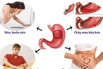  Loét dạ dày do bỏ bữa sáng
