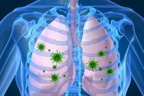 Bệnh viêm phổi có nguy hiểm không? Điều trị bao lâu thì khỏi?