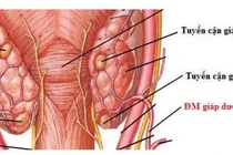 Cắt bỏ u tuyến cận giáp là phương pháp hiệu quả