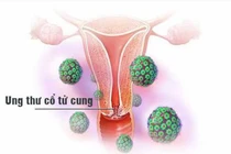  HPV dương tính có phải đã bị ung thư tử cung?