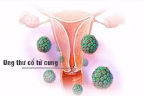  HPV dương tính có phải đã bị ung thư tử cung?