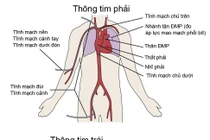  Chuẩn bị trước khi thông tim