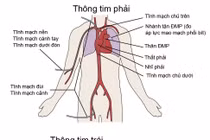 Chuẩn bị trước khi thông tim