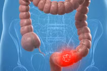 Phát hiện sớm ung thư đại trực tràng