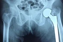 Gãy xương vùng khớp háng ở người cao tuổi: Chưa được quan tâm đúng mức?