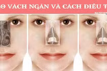  Vẹo vách ngăn vì chủ quan với nghẹt mũi 