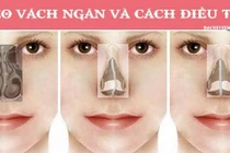  Vẹo vách ngăn vì chủ quan với nghẹt mũi 