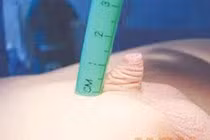 Biểu hiện vùi dương vật