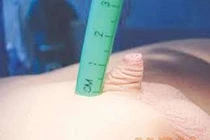 Biểu hiện vùi dương vật