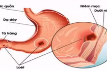 Phẫu thuật tăng cường độ chặt của cơ thắt thực quản