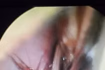 Nam thanh niên bị gián chui vào sống trong tai khi đang ngủ 