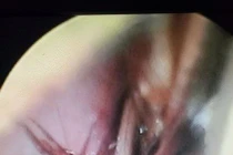 Nam thanh niên bị gián chui vào sống trong tai khi đang ngủ 