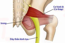 Hội chứng cơ tháp