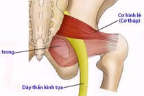 Hội chứng cơ tháp
